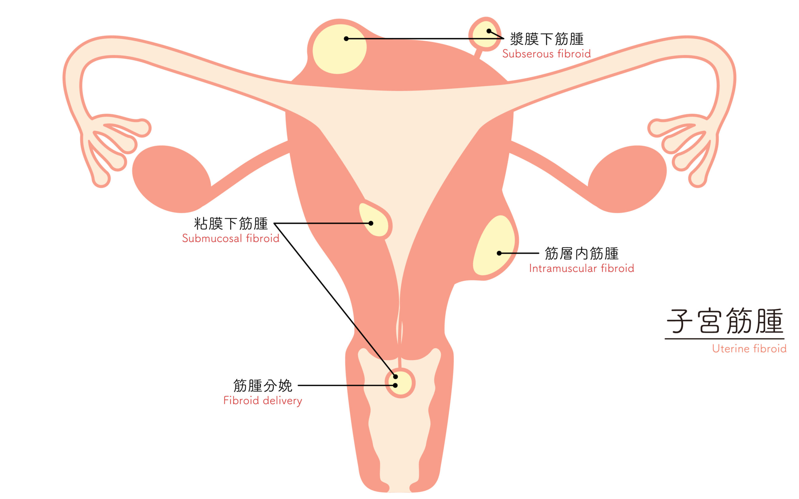 子宮筋腫