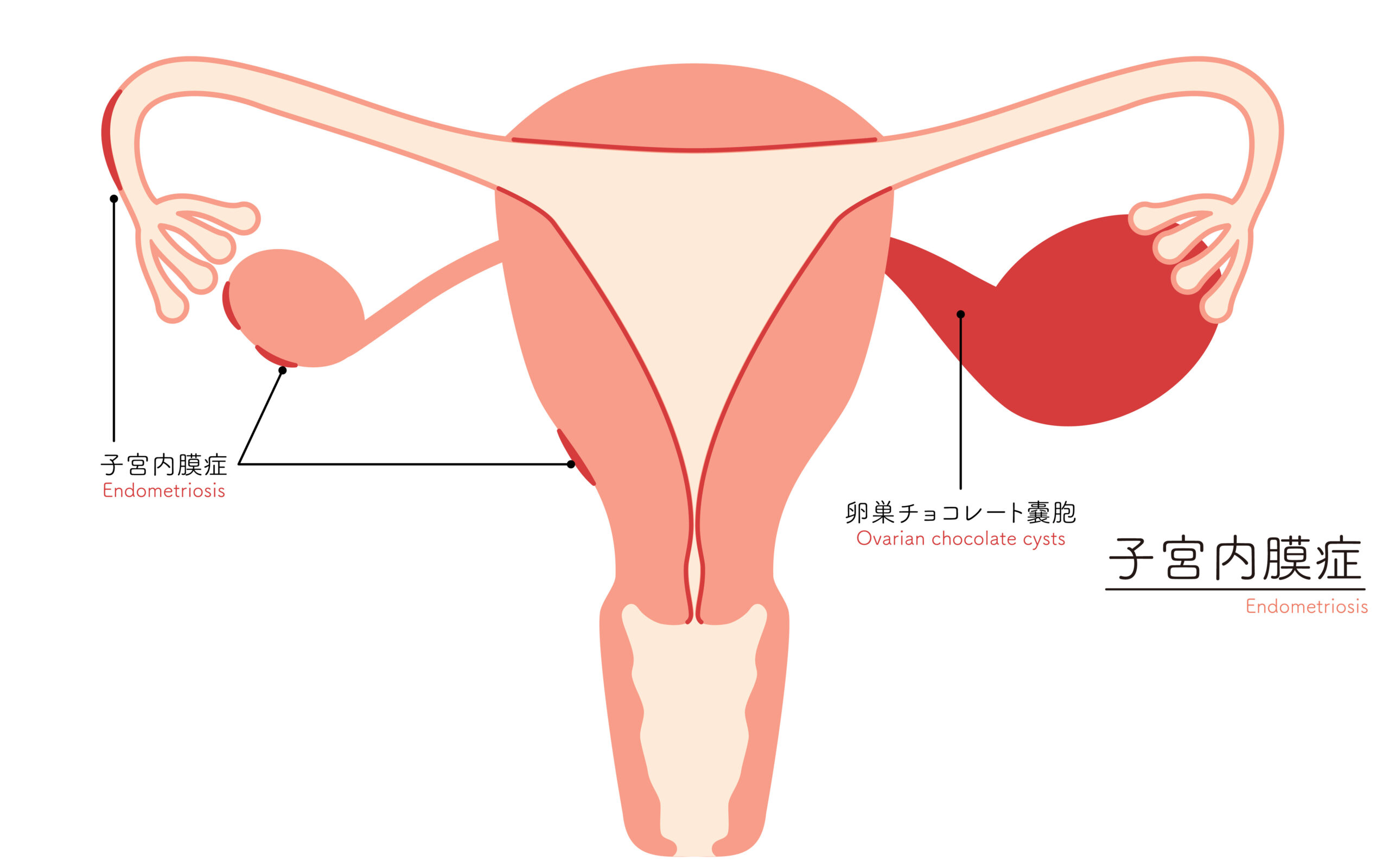 子宮内膜症