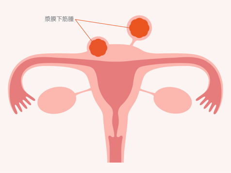 1. 漿膜下筋腫（しょうまくかきんしゅ）