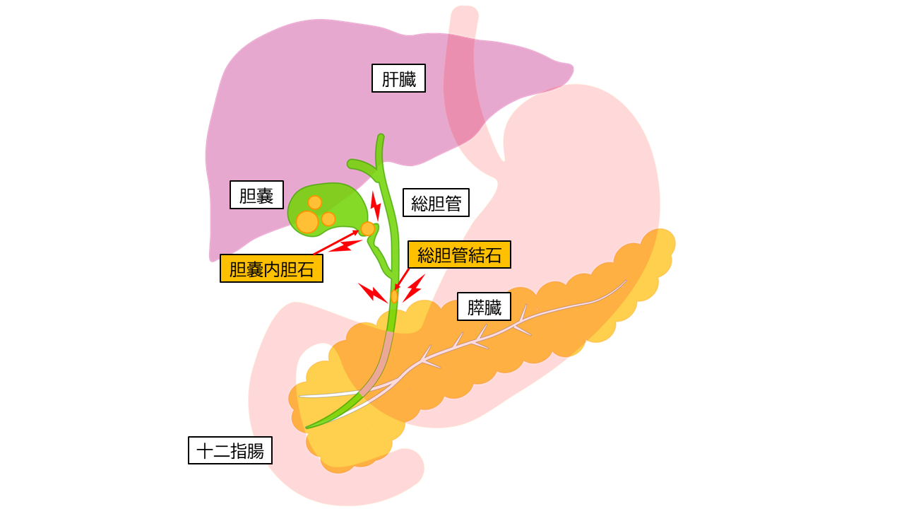 胆石(胆嚢内胆石・総胆管結石)とは?原因から症状・治療法・予防まで|横浜市横浜駅前の消化器内科・婦人科・内科|横浜駅前ながしまクリニック
