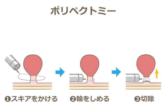 ポリペクトミー