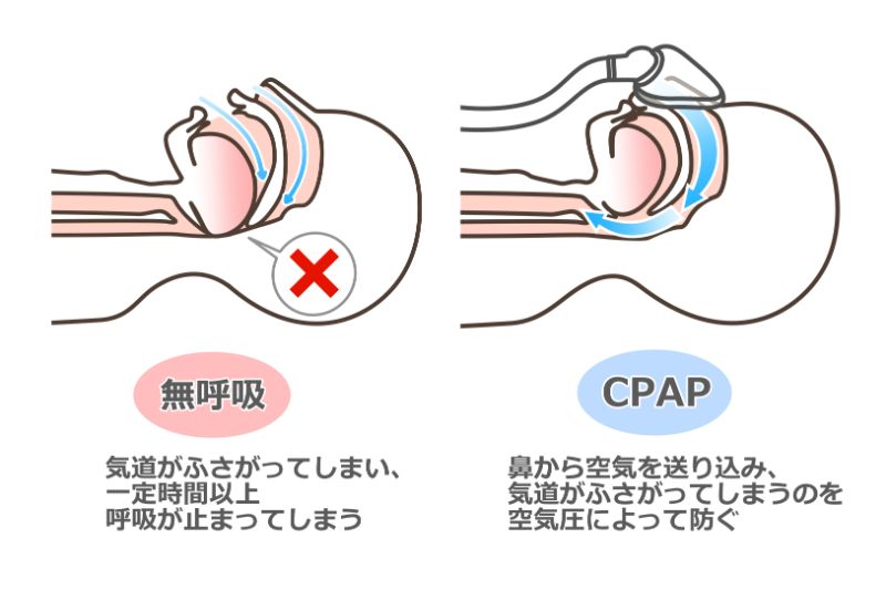 CPAP療法（持続陽圧呼吸療法）